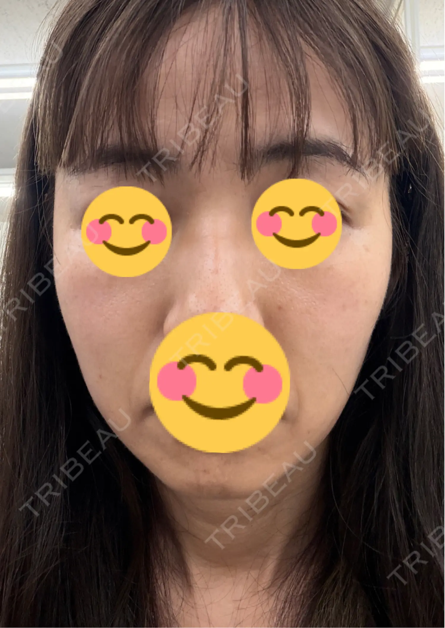 施術後の写真
