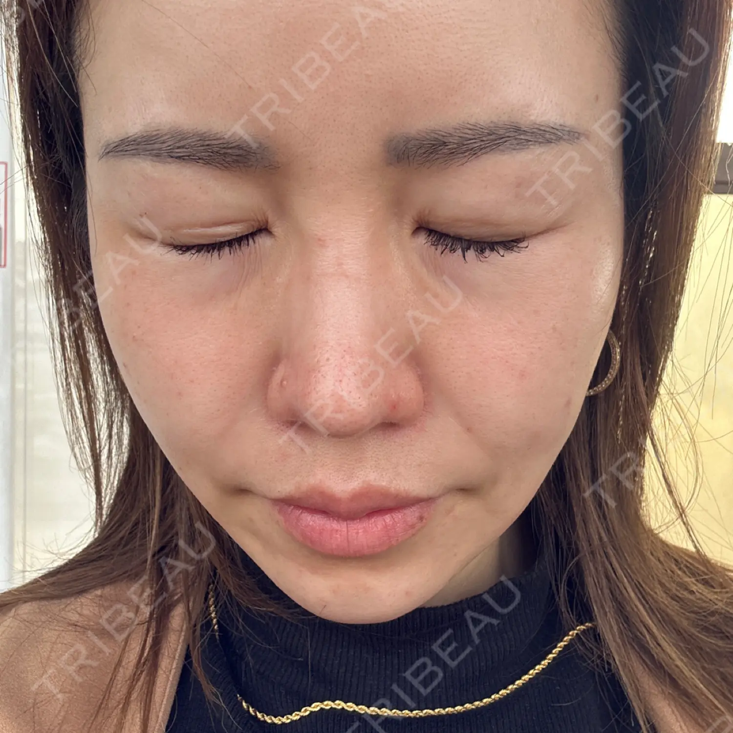 施術後の写真