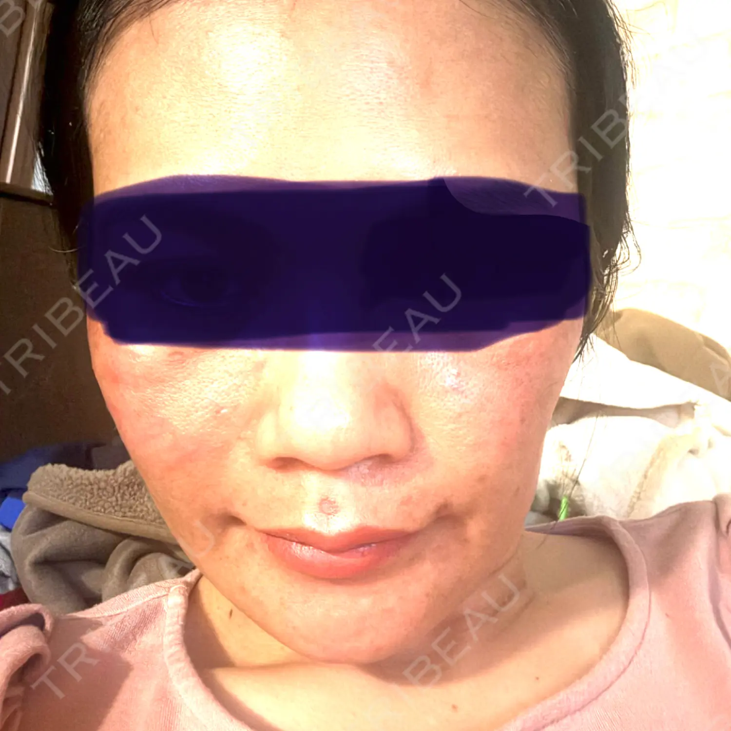施術後の写真