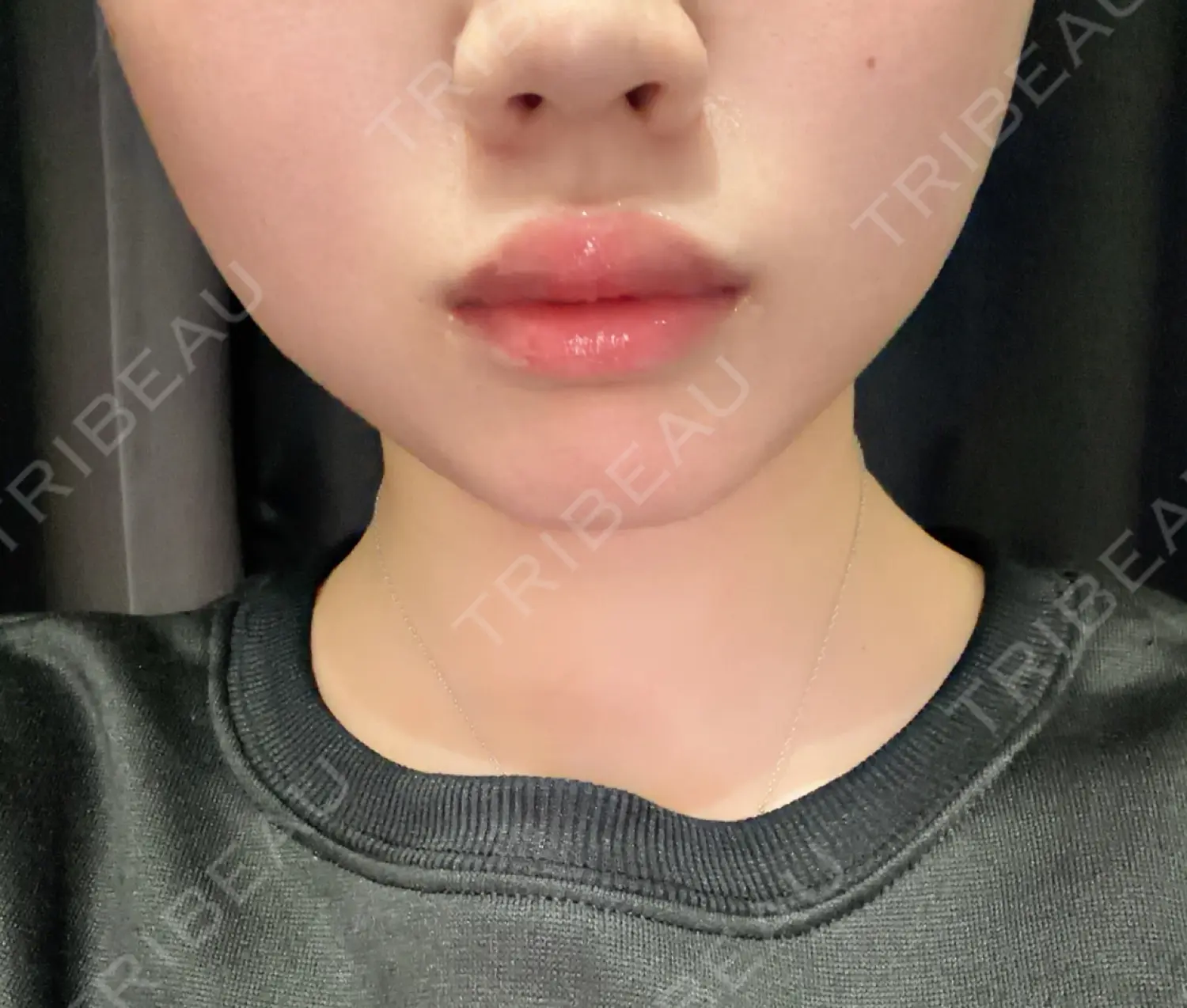 施術後の写真