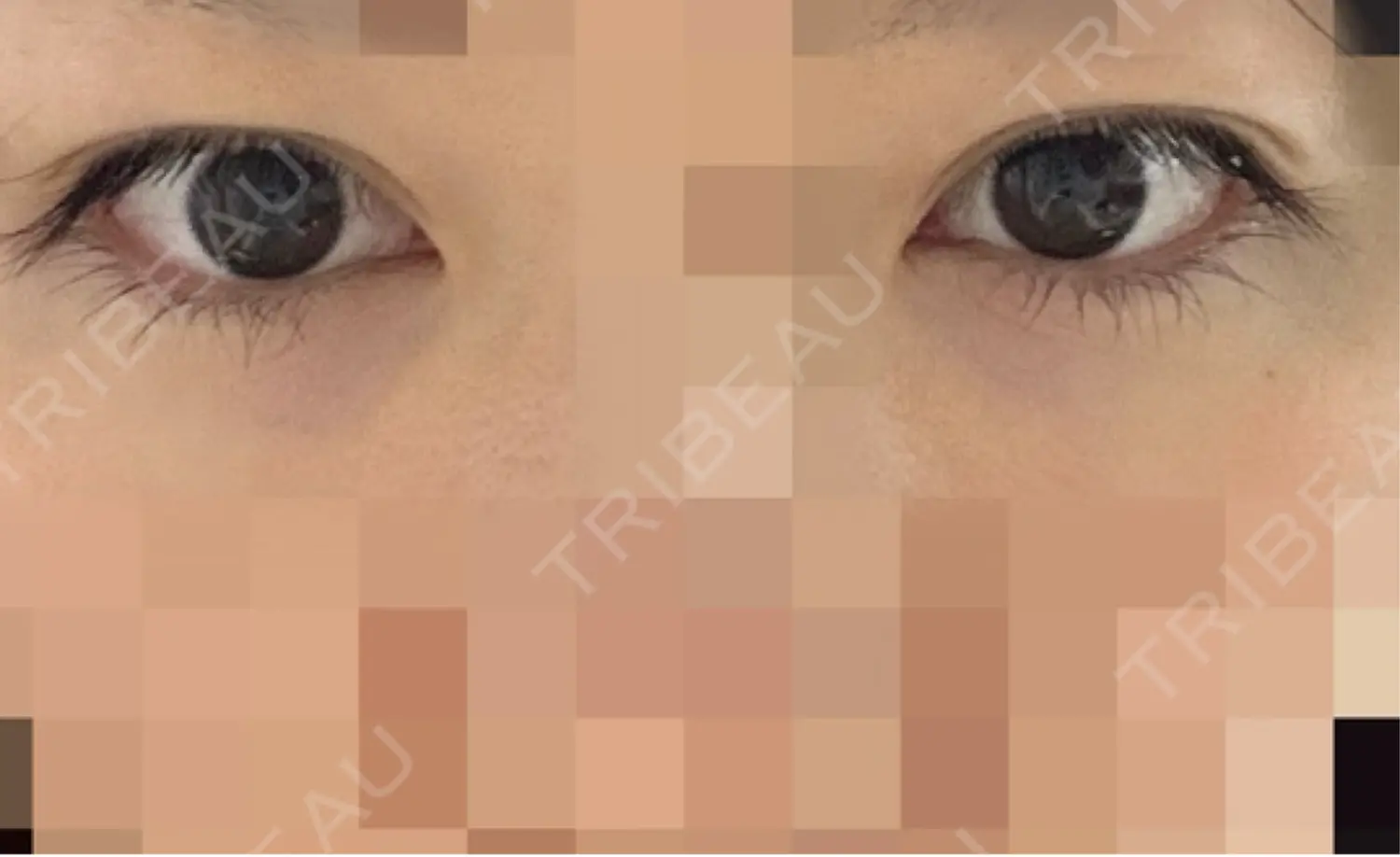 施術後の写真