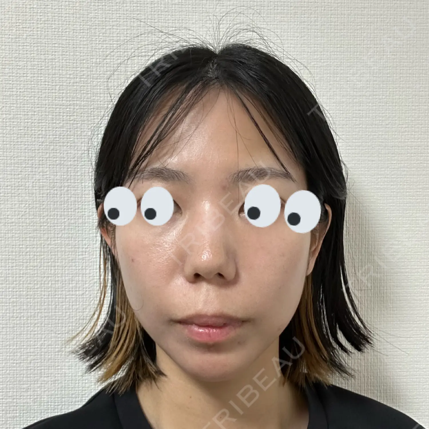 施術後の写真