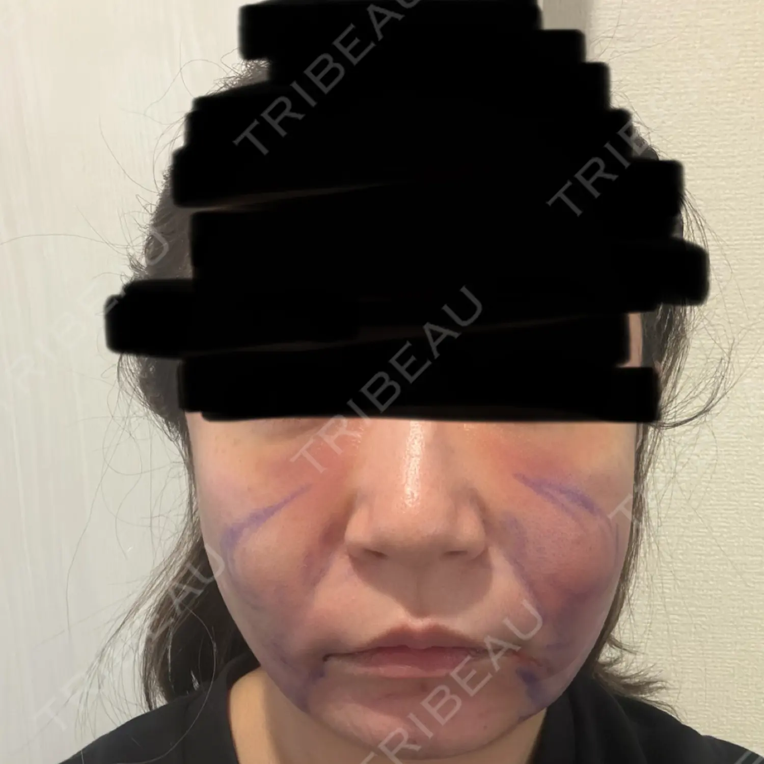 施術後の写真