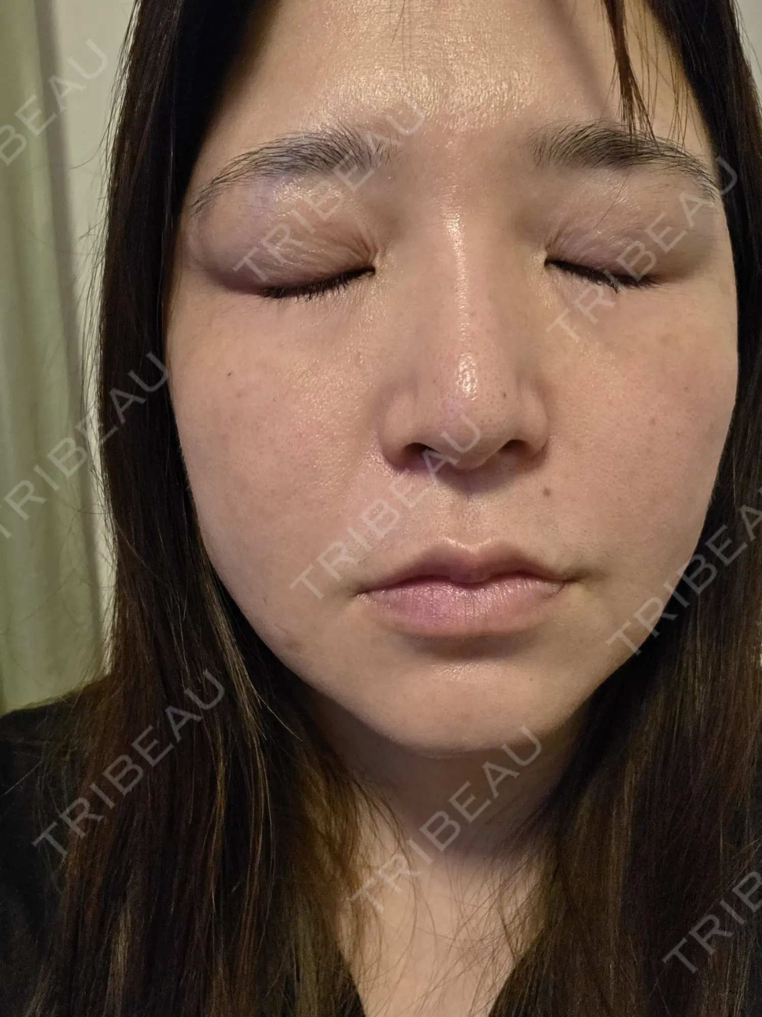 施術後の写真