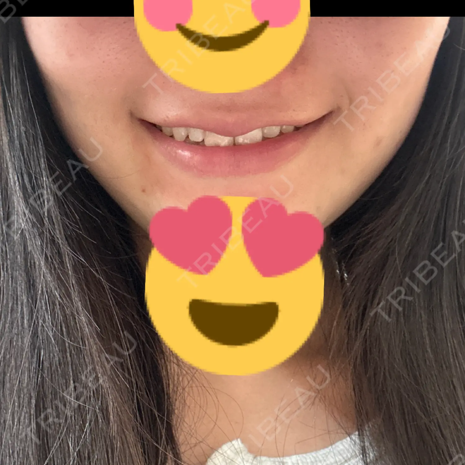 施術後の写真