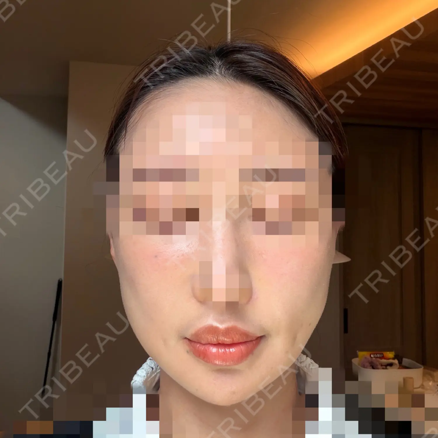 施術後の写真