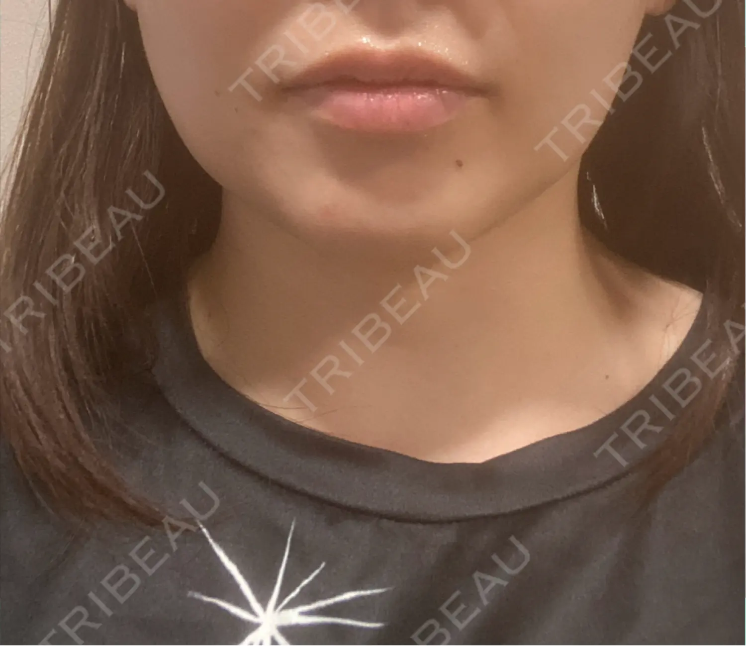 施術後の写真