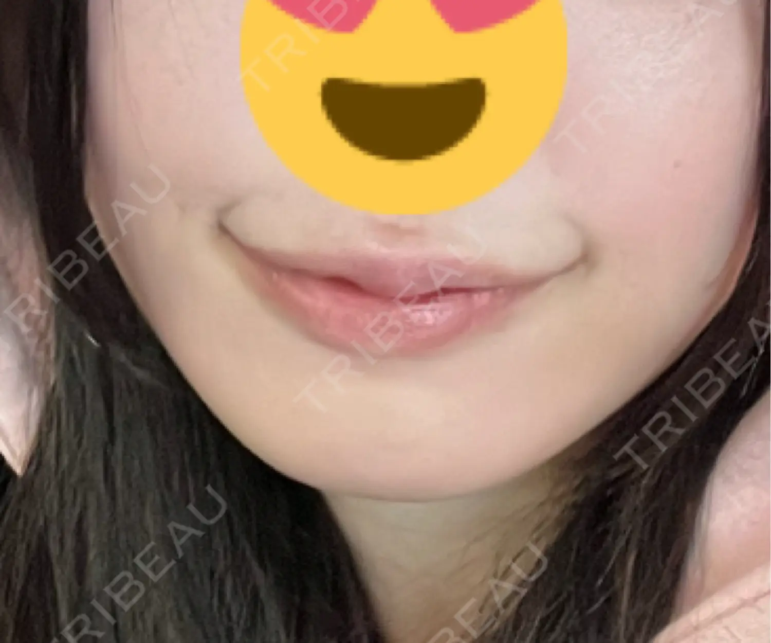 施術後の写真
