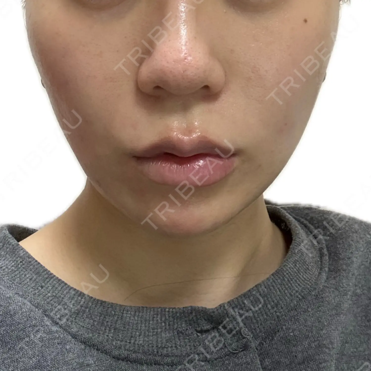 施術後の写真
