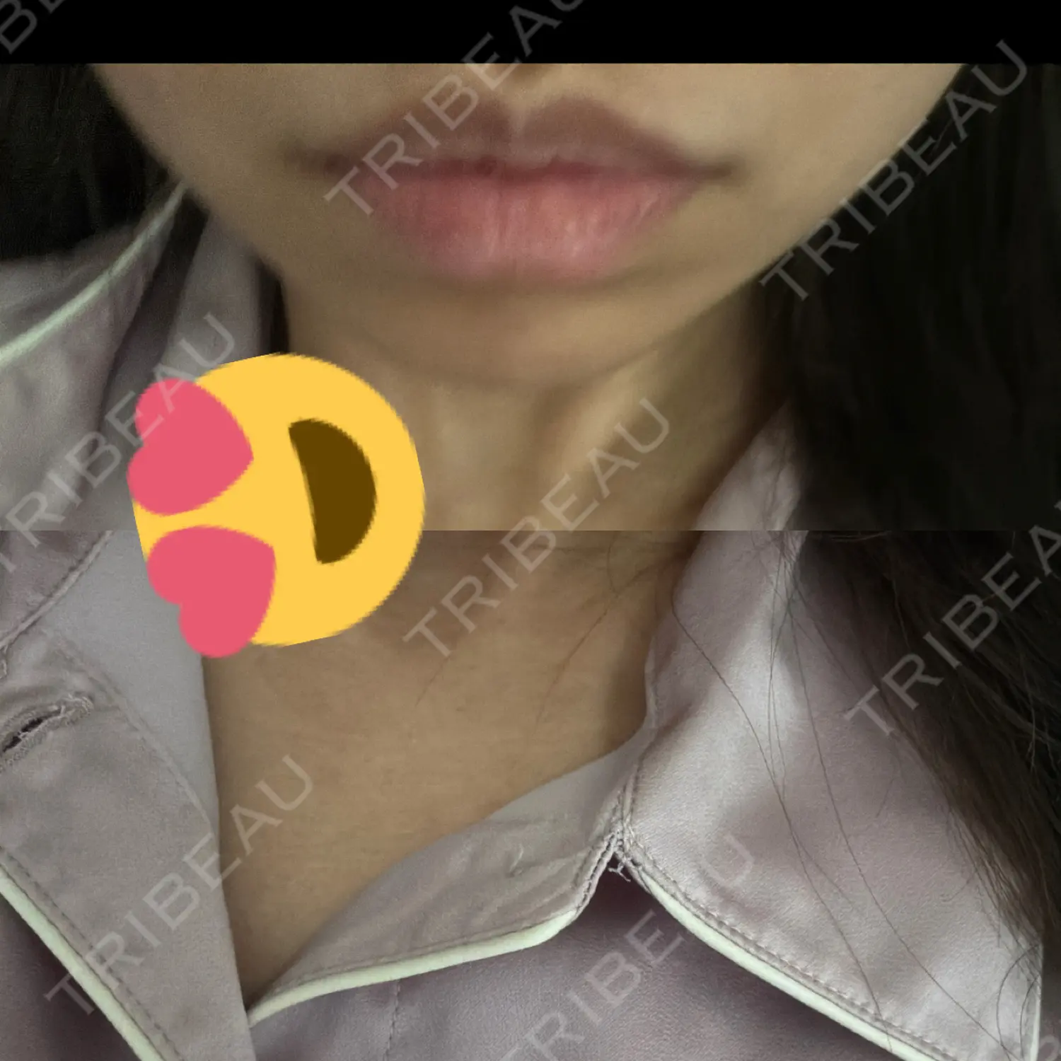 施術後の写真