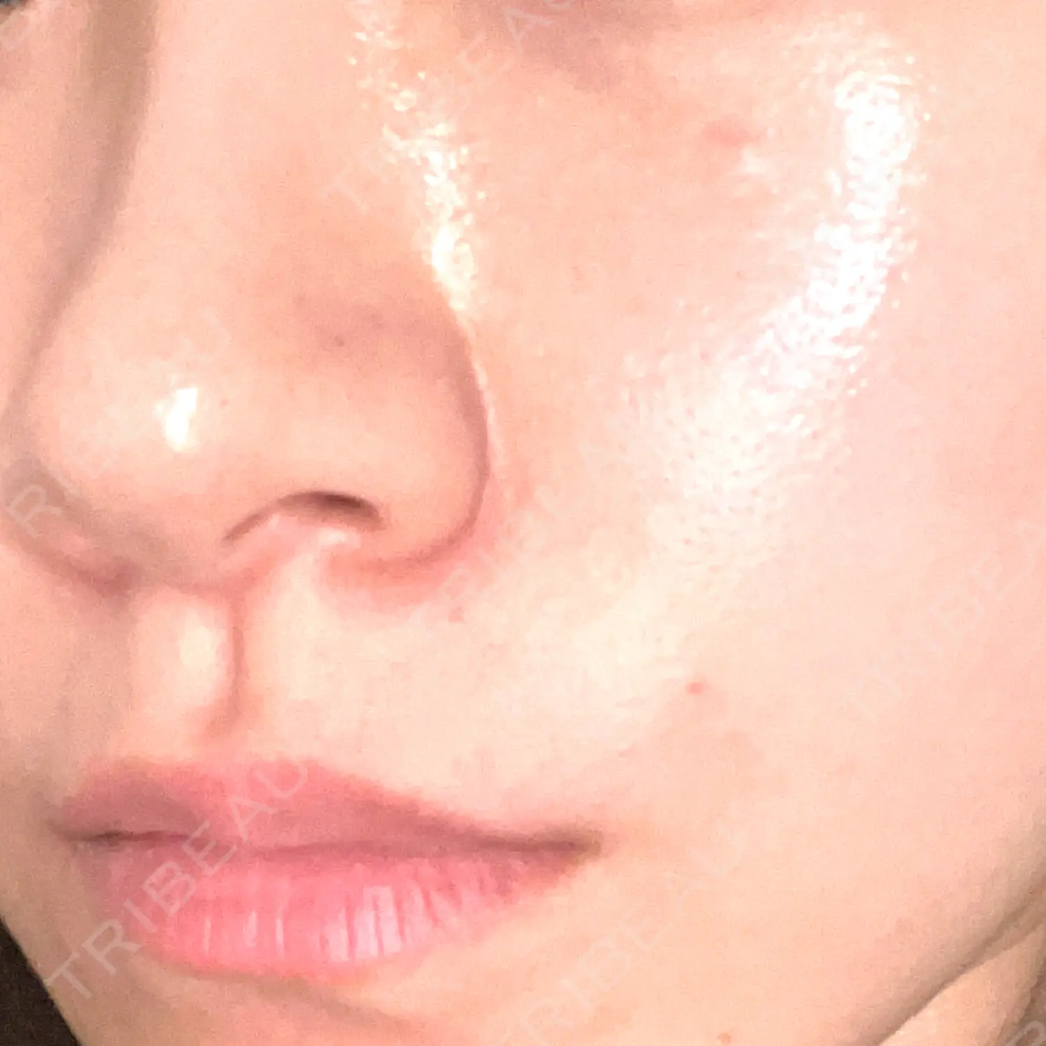 施術後の写真