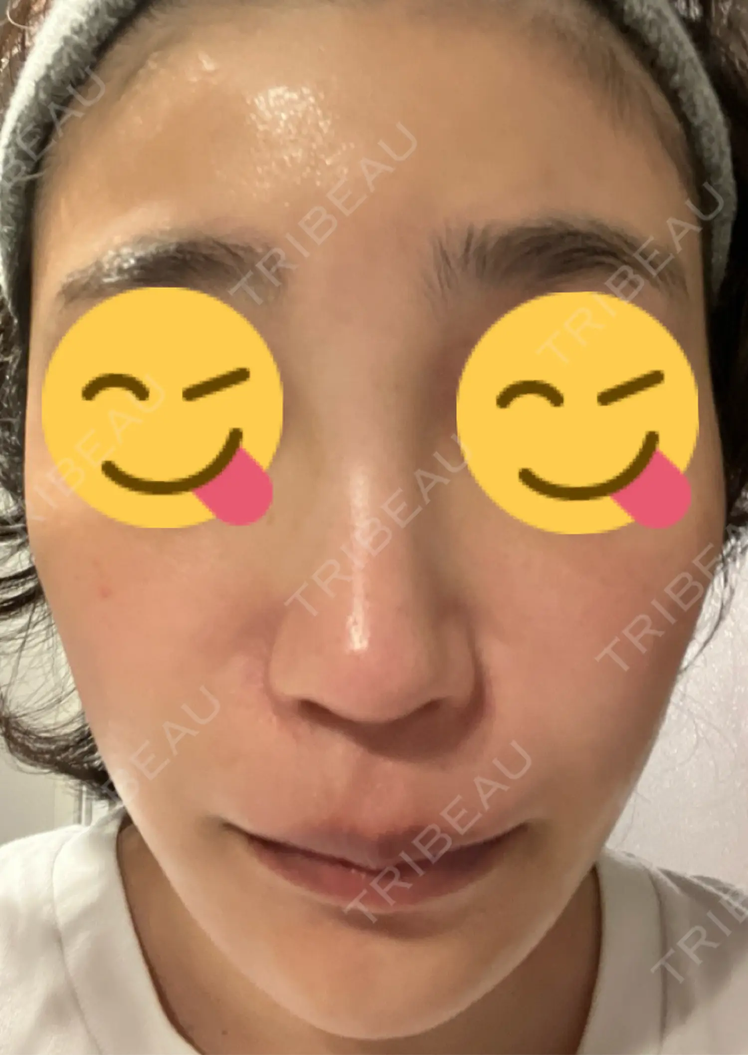 施術後の写真
