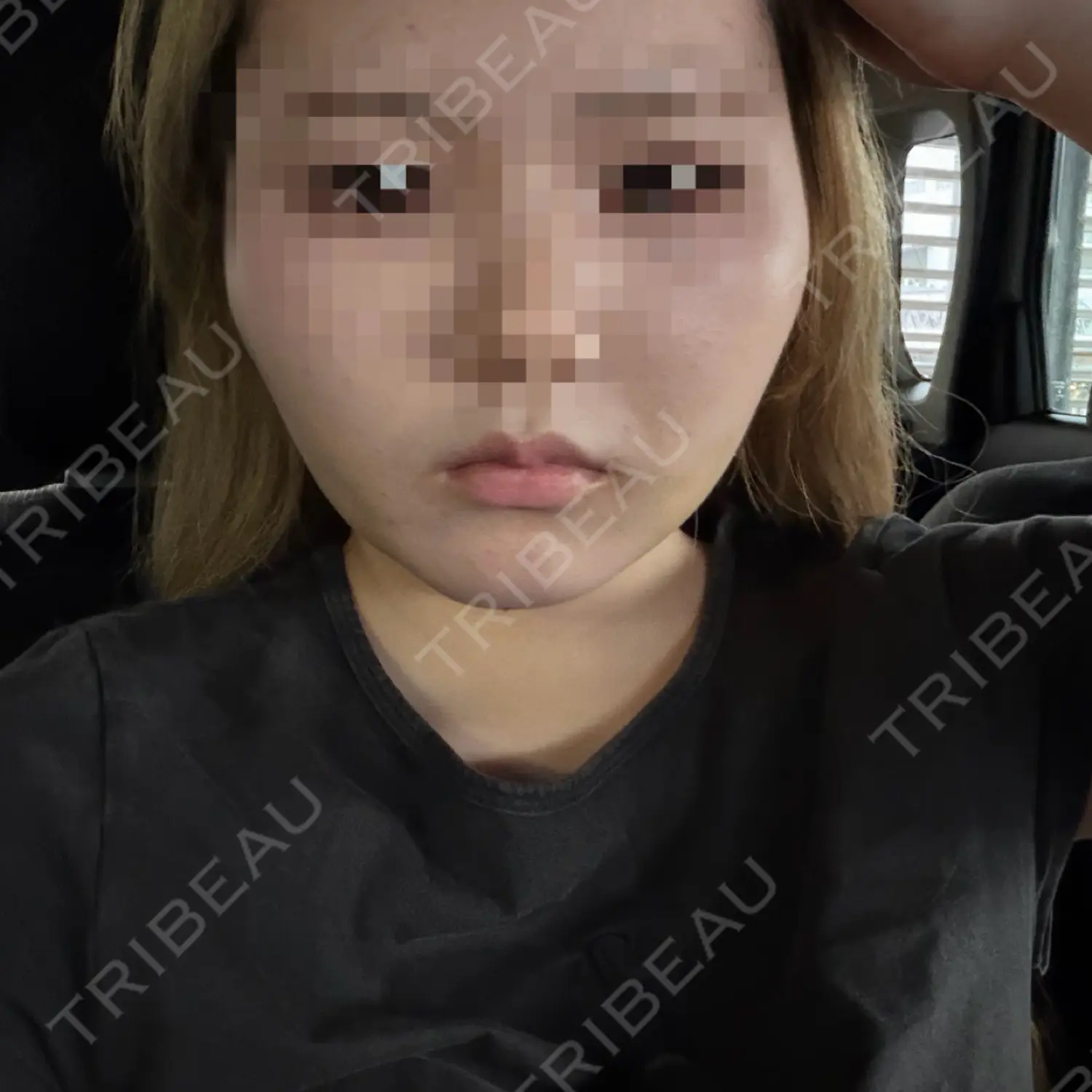 施術後の写真