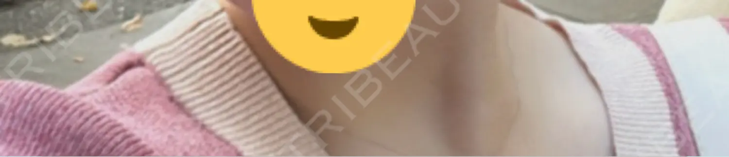 施術後の写真