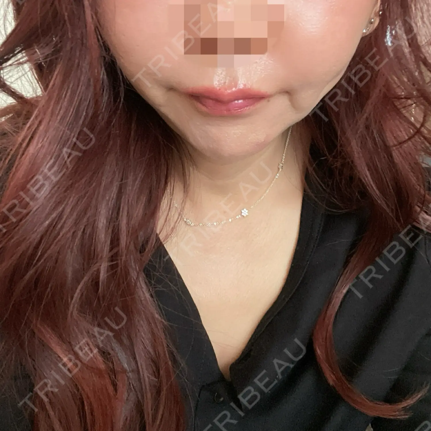 施術後の写真