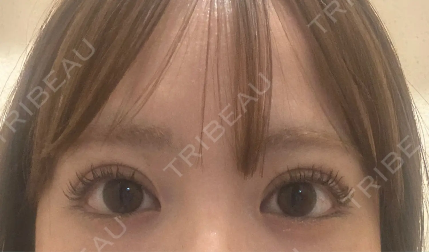 施術後の写真