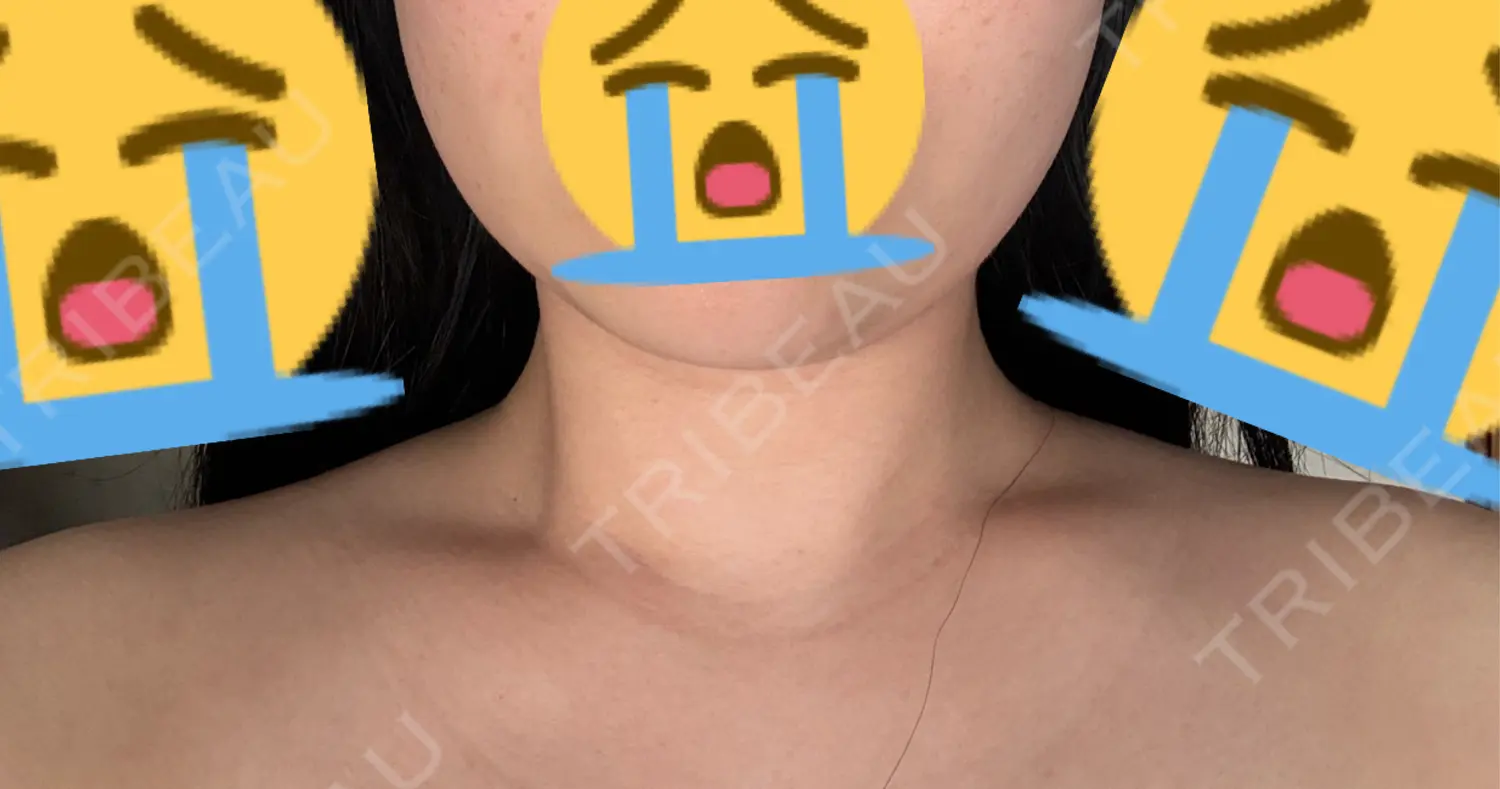 施術後の写真