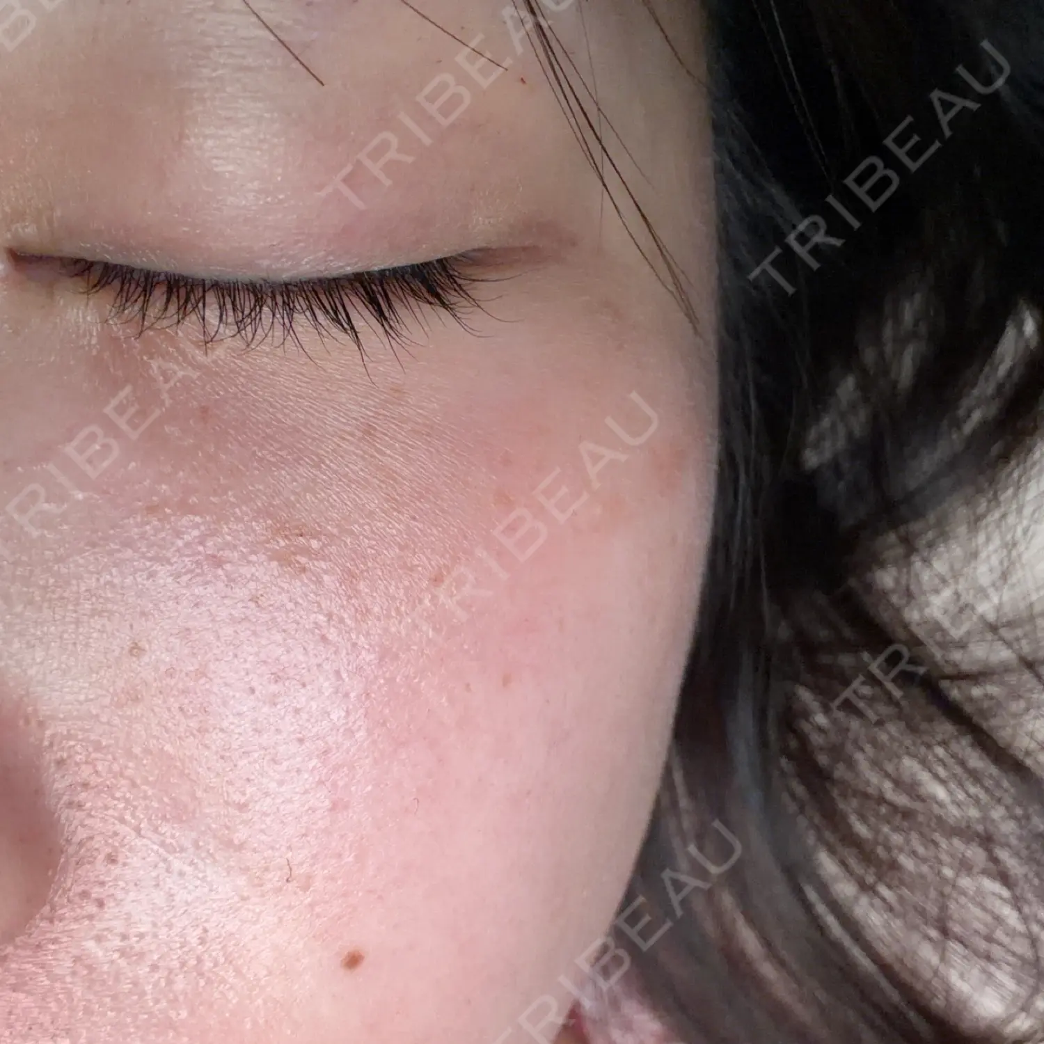 施術後の写真
