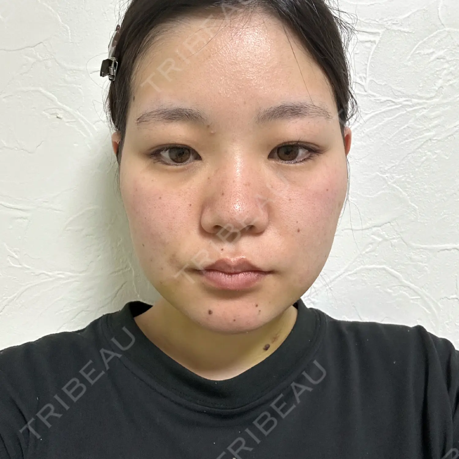 施術後の写真