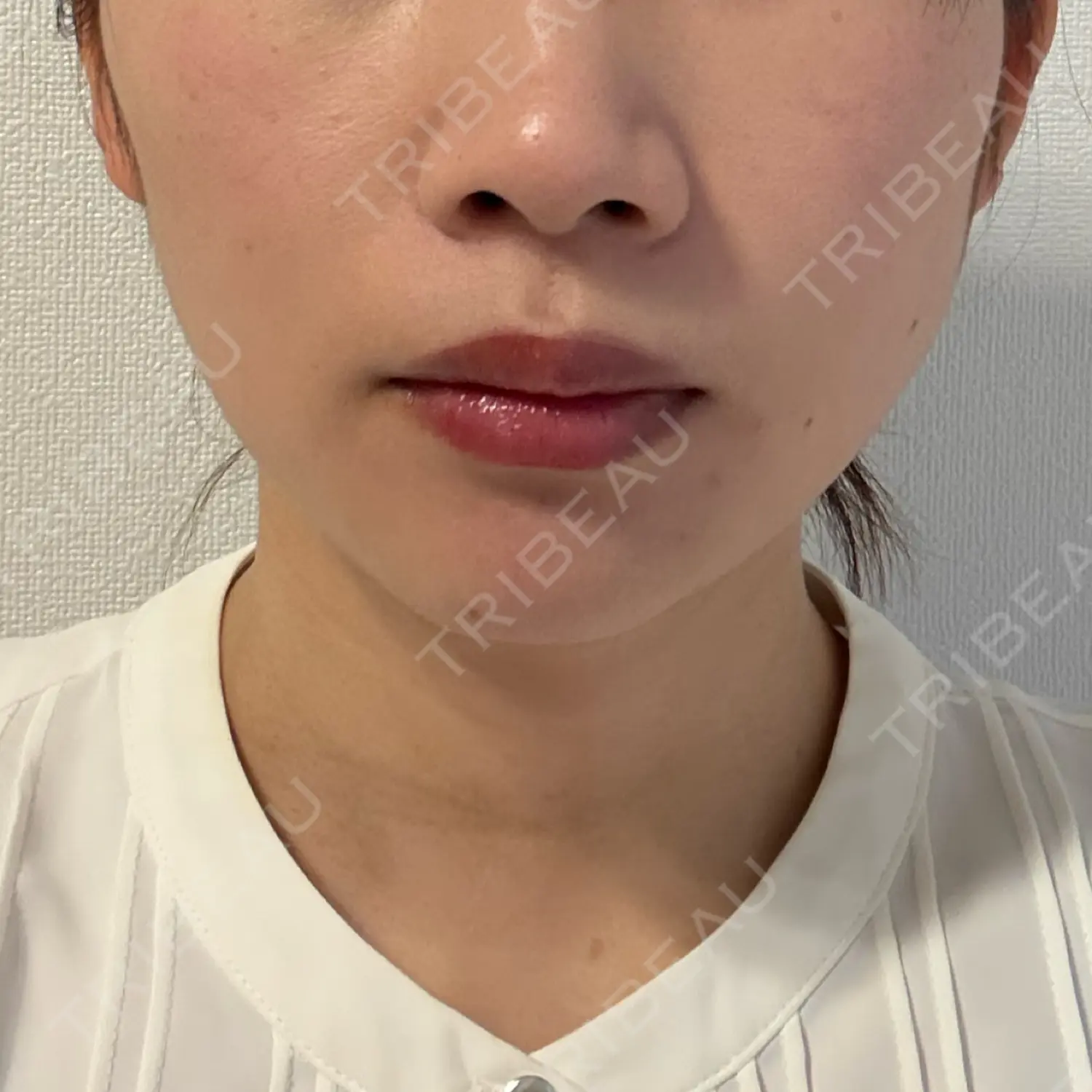 施術後の写真