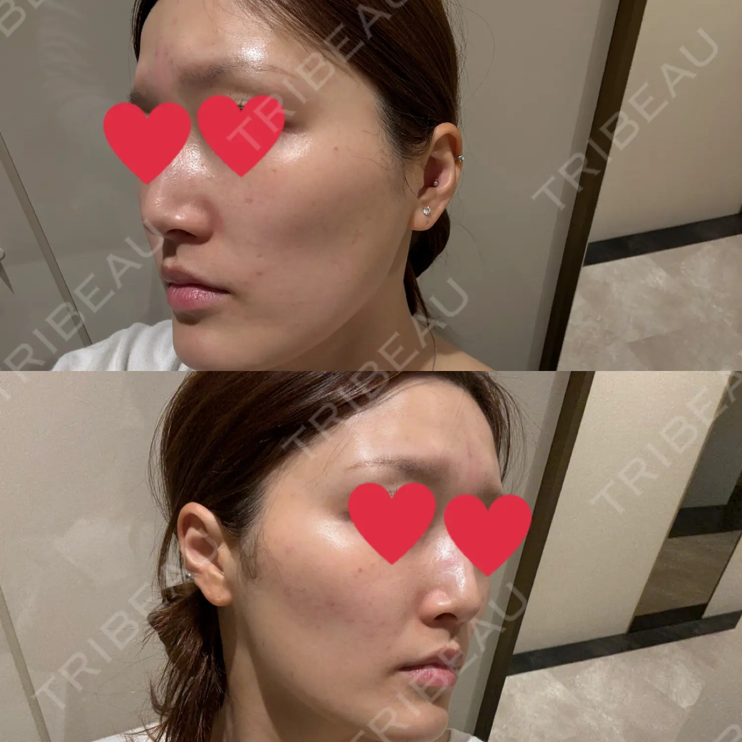 施術後の写真
