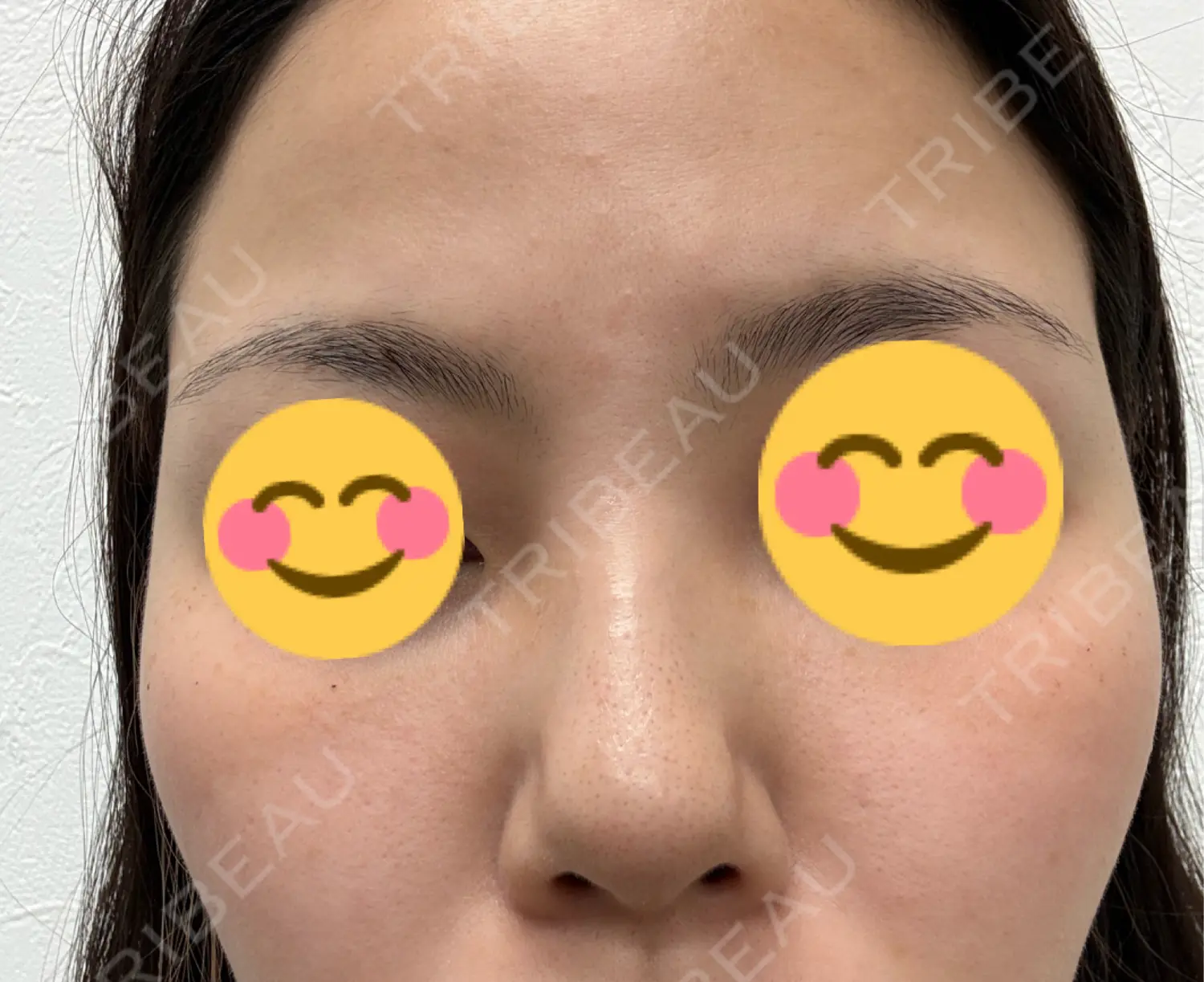 施術後の写真