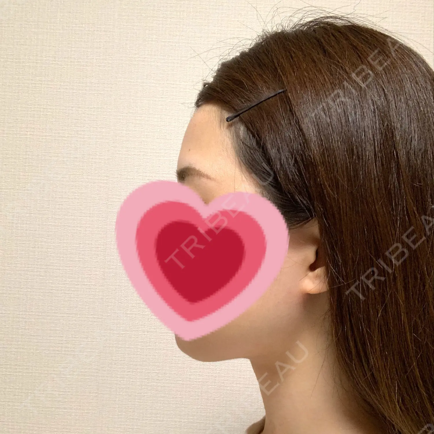 施術後の写真