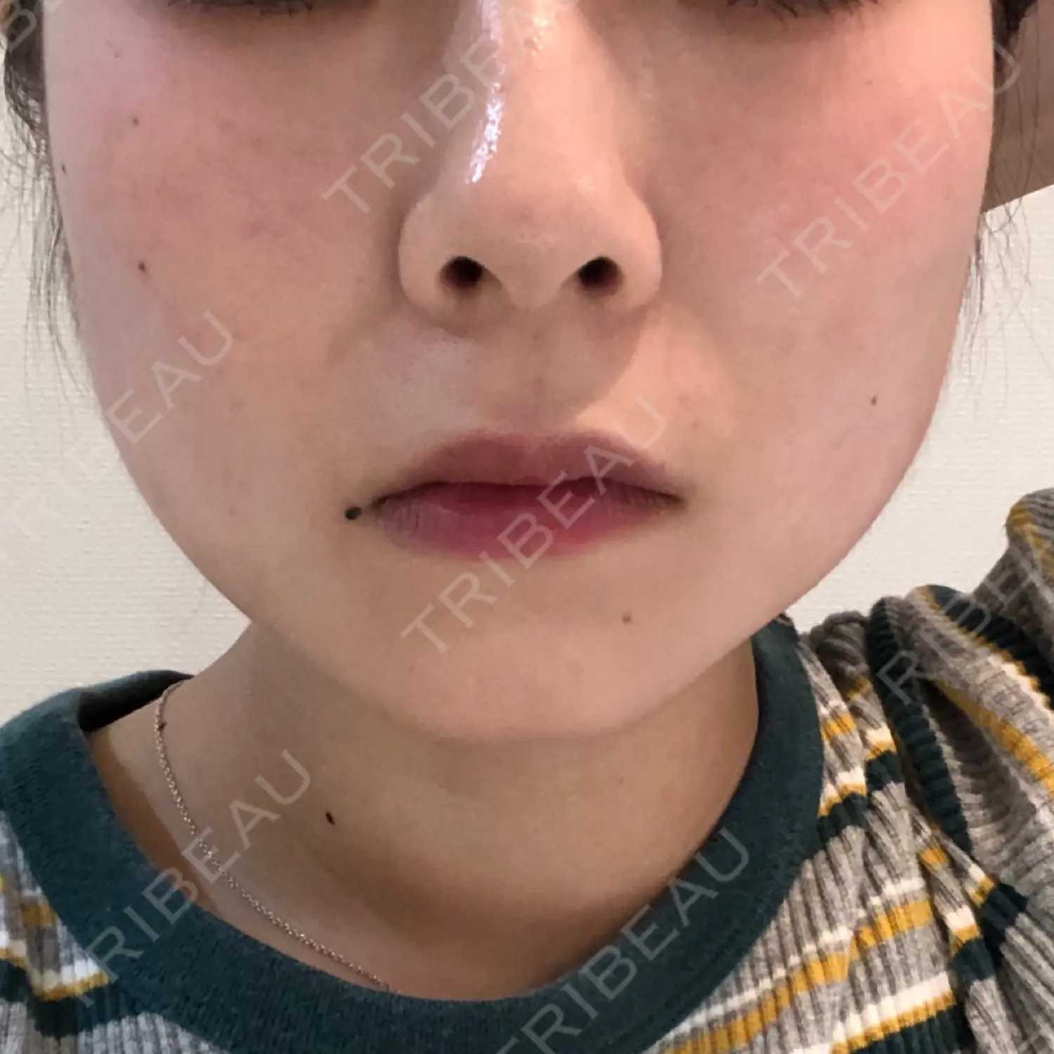施術後の写真