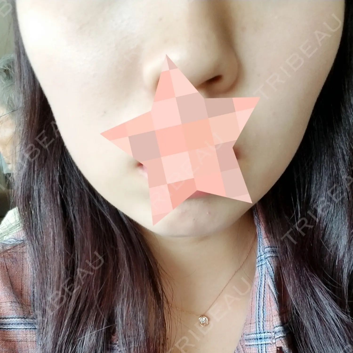 施術後の写真