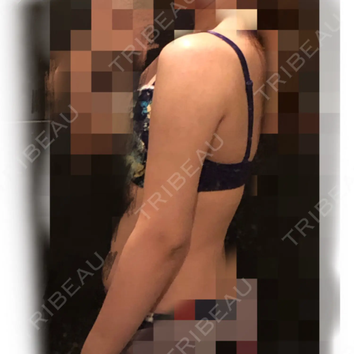 施術後の写真