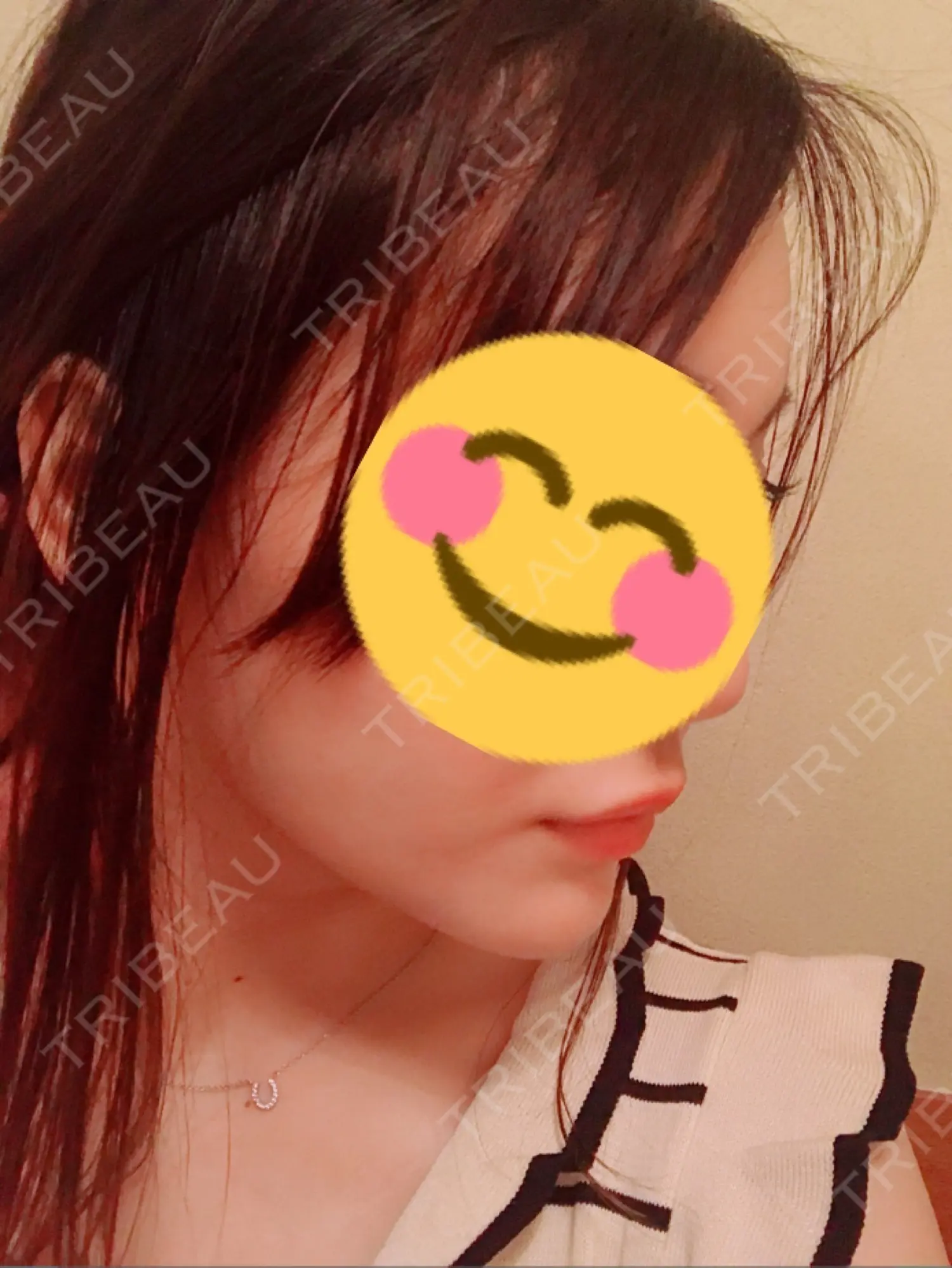 施術後の写真