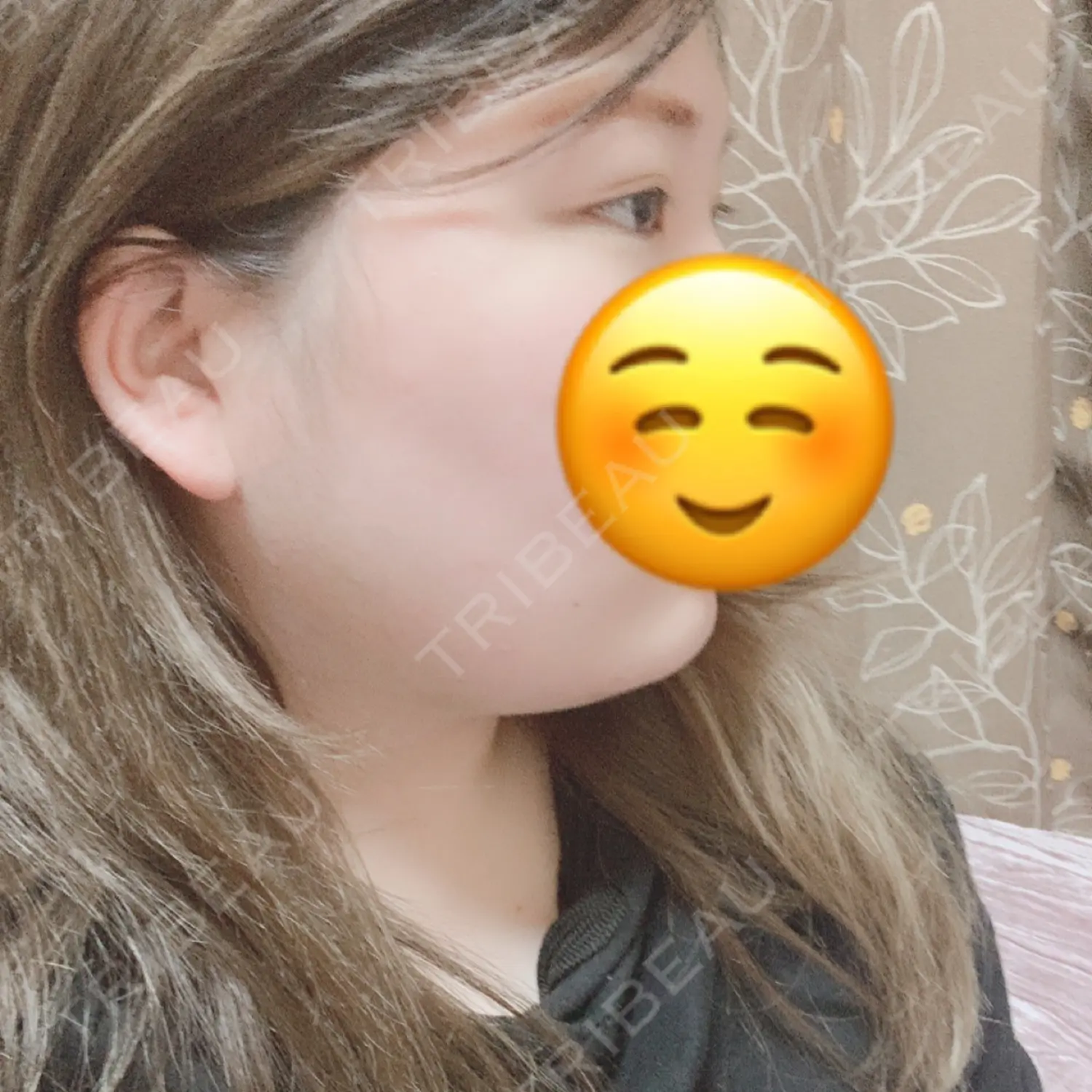 施術後の写真