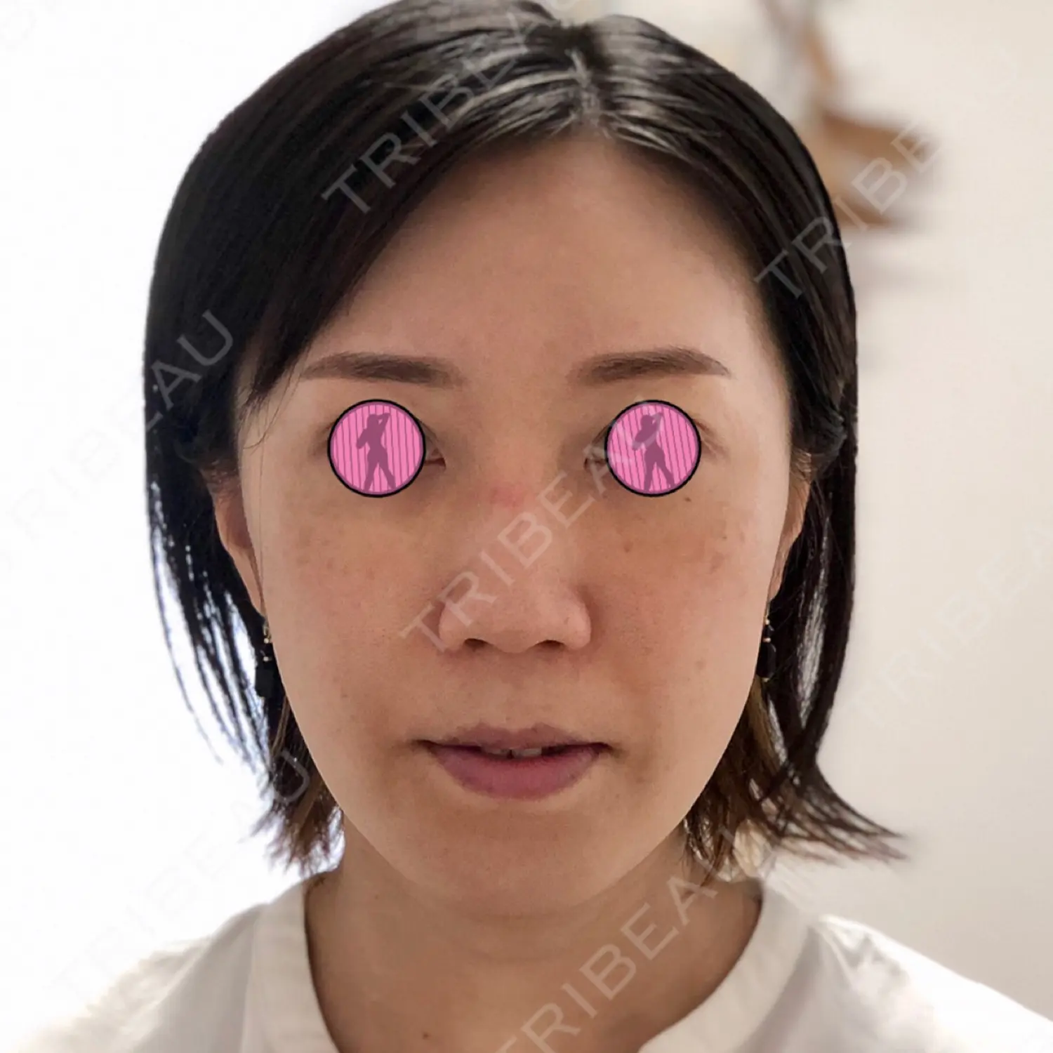 施術後の写真