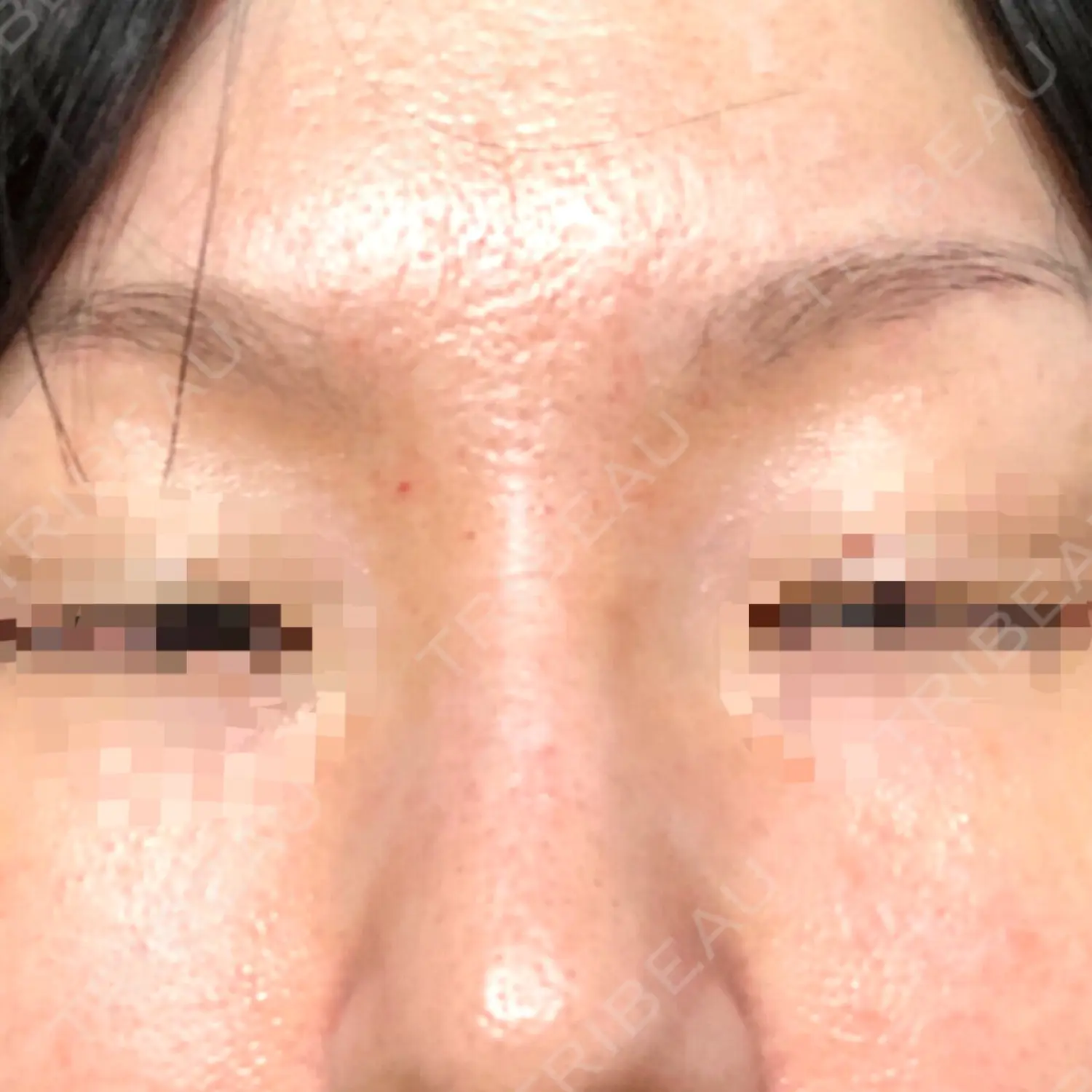 施術後の写真