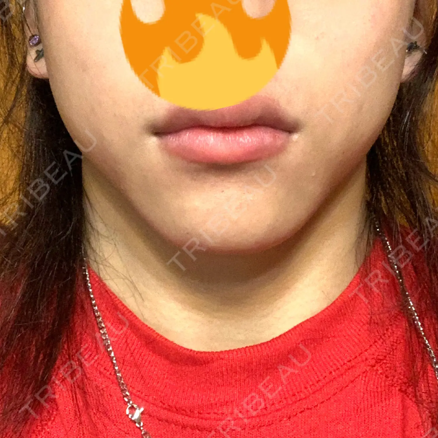施術後の写真