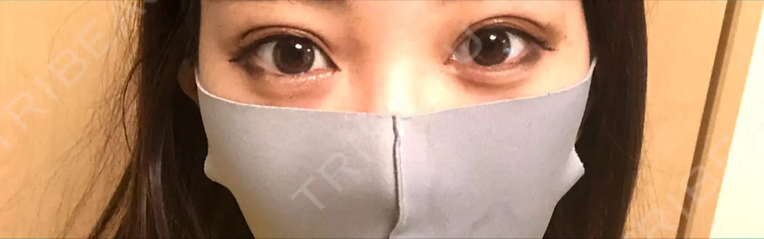施術後の写真
