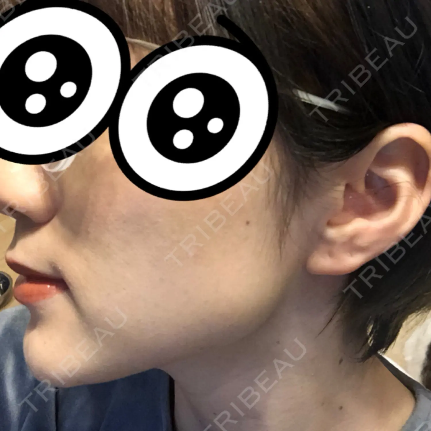 施術後の写真