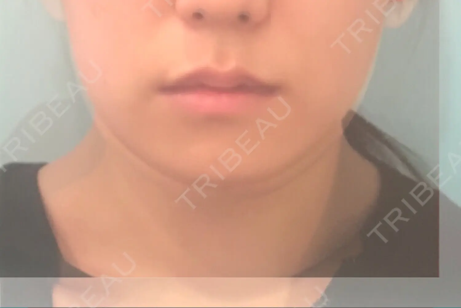 施術後の写真