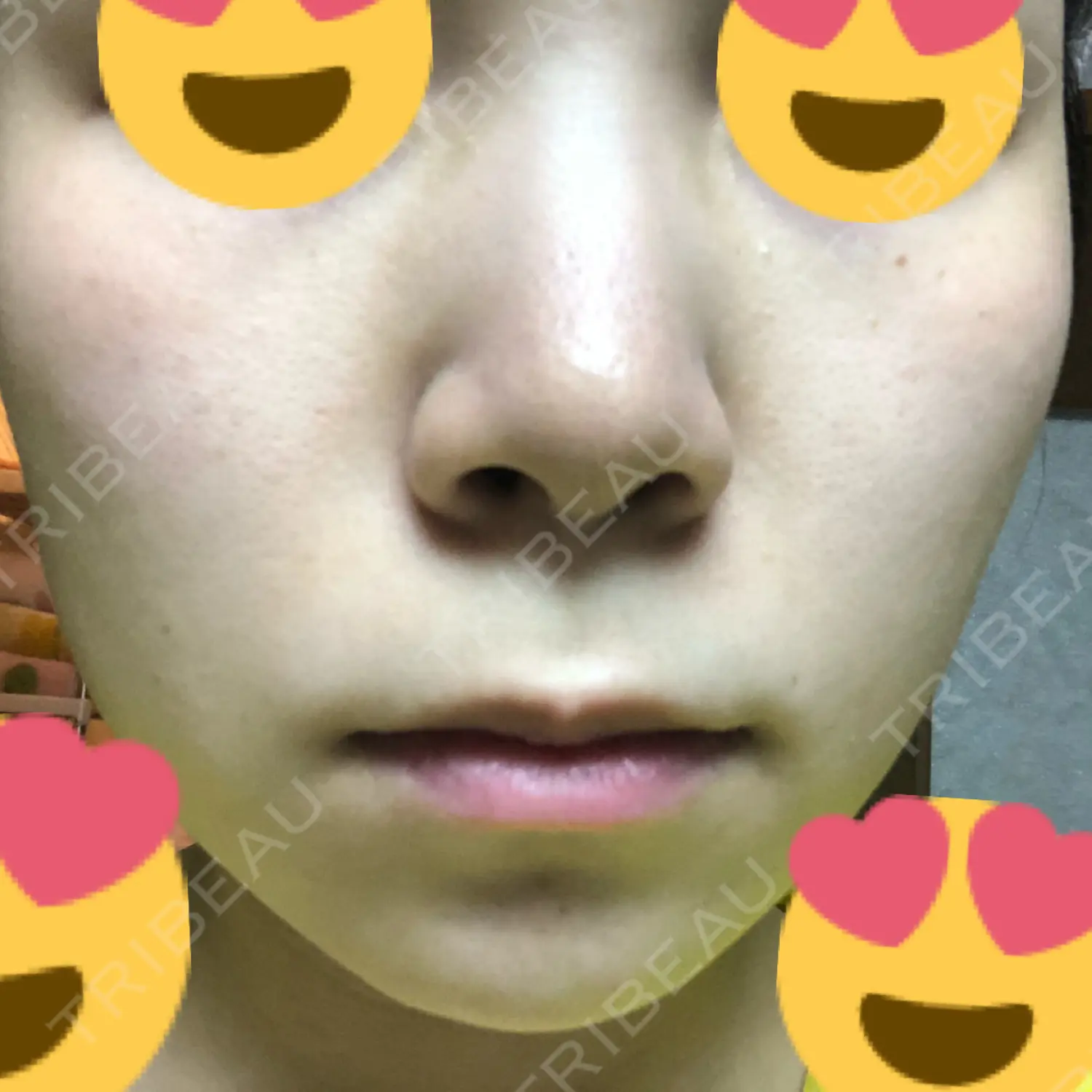施術後の写真
