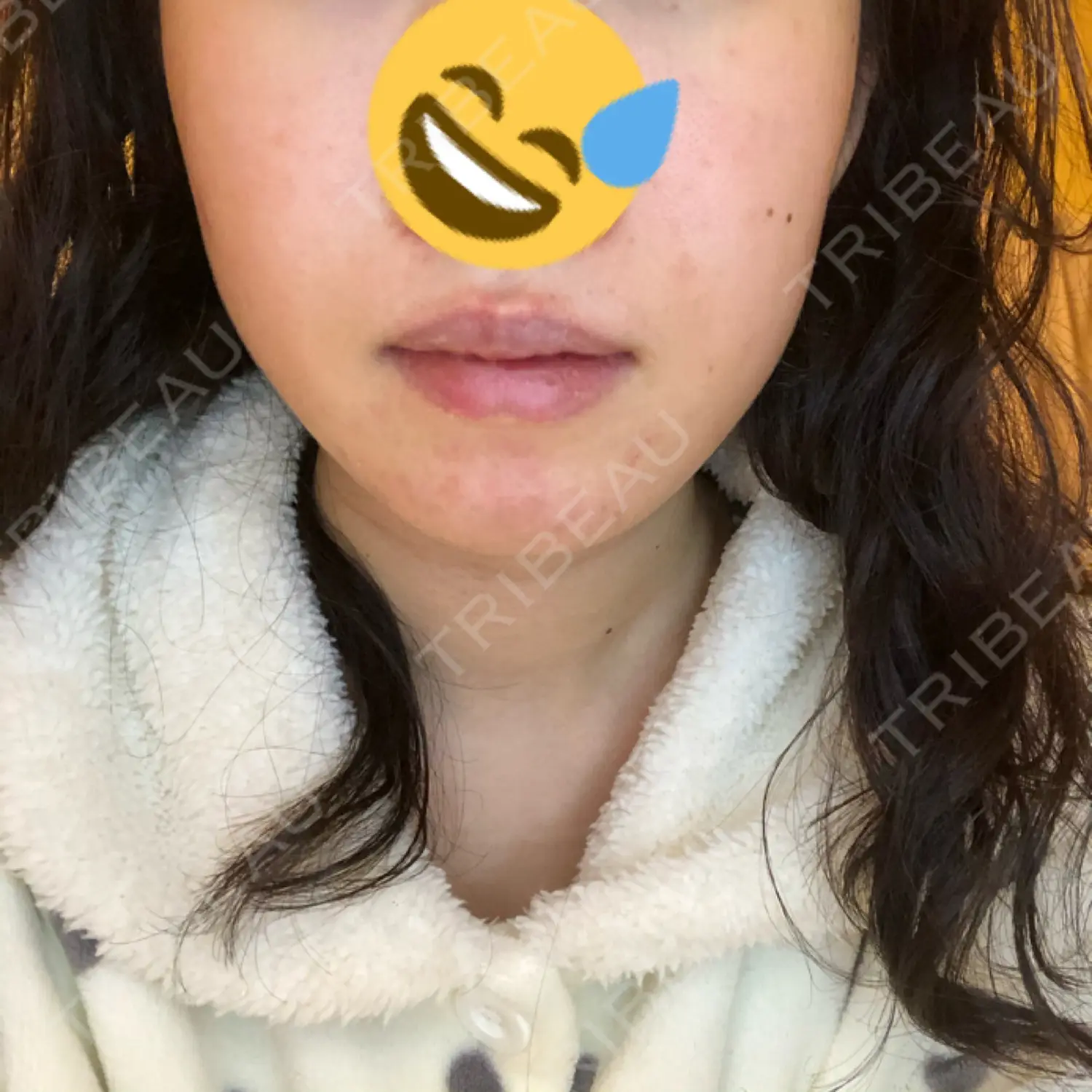 施術後の写真