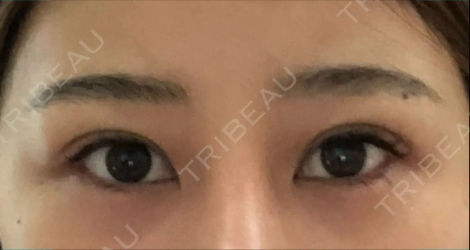 施術後の写真