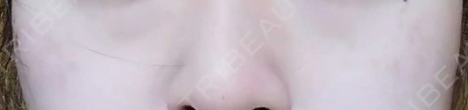 施術後の写真