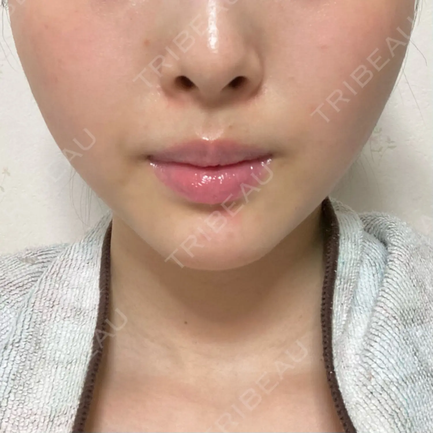 施術後の写真