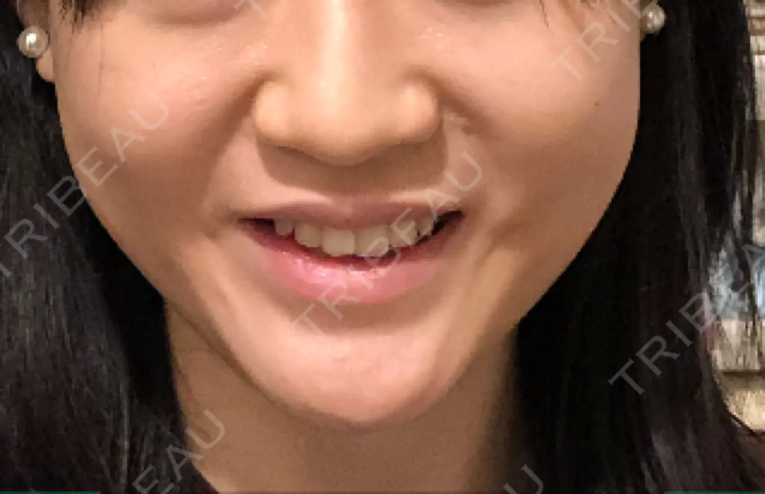 施術後の写真