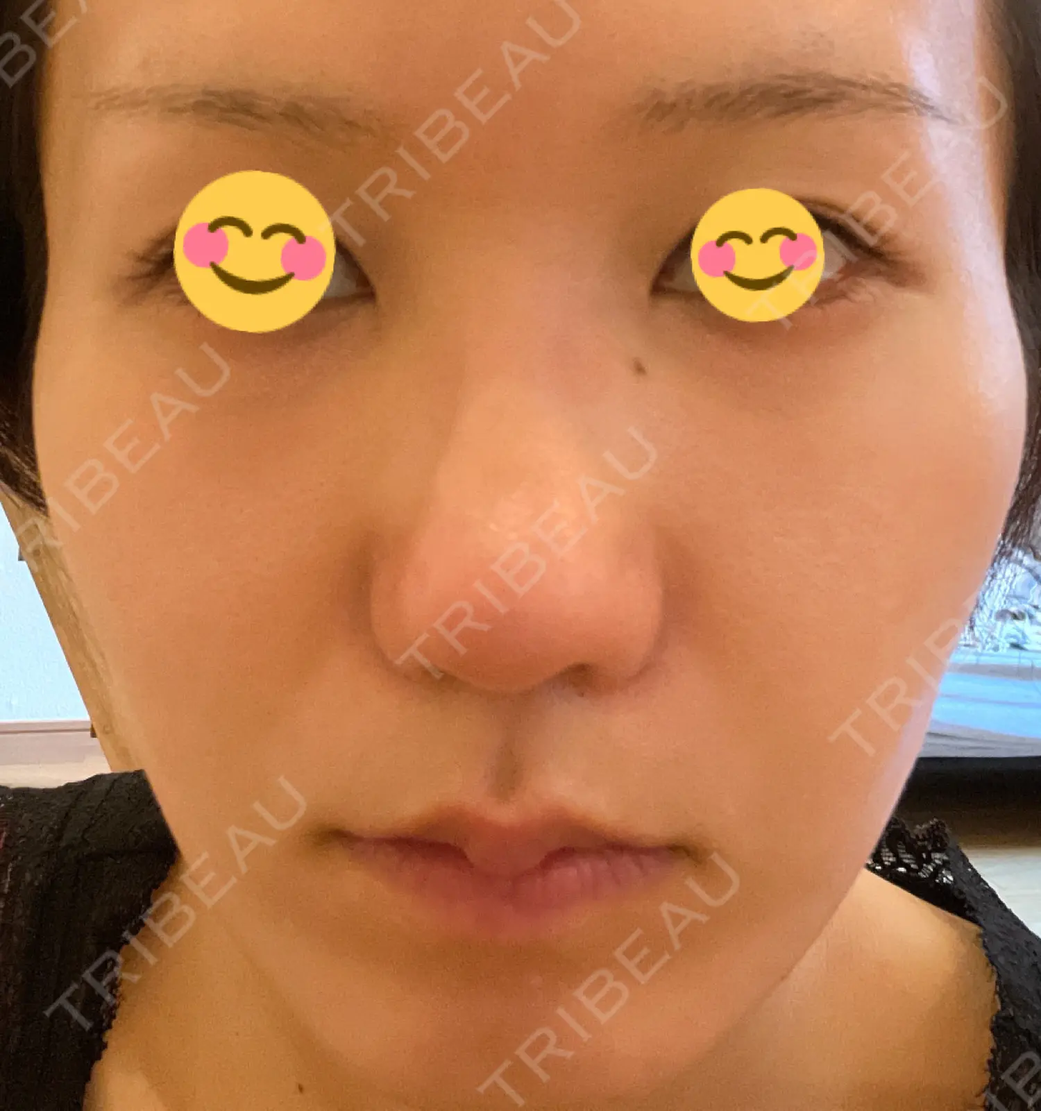 施術後の写真