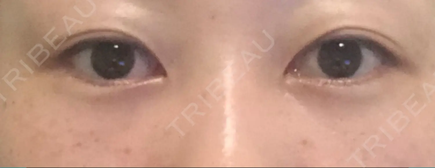 施術後の写真