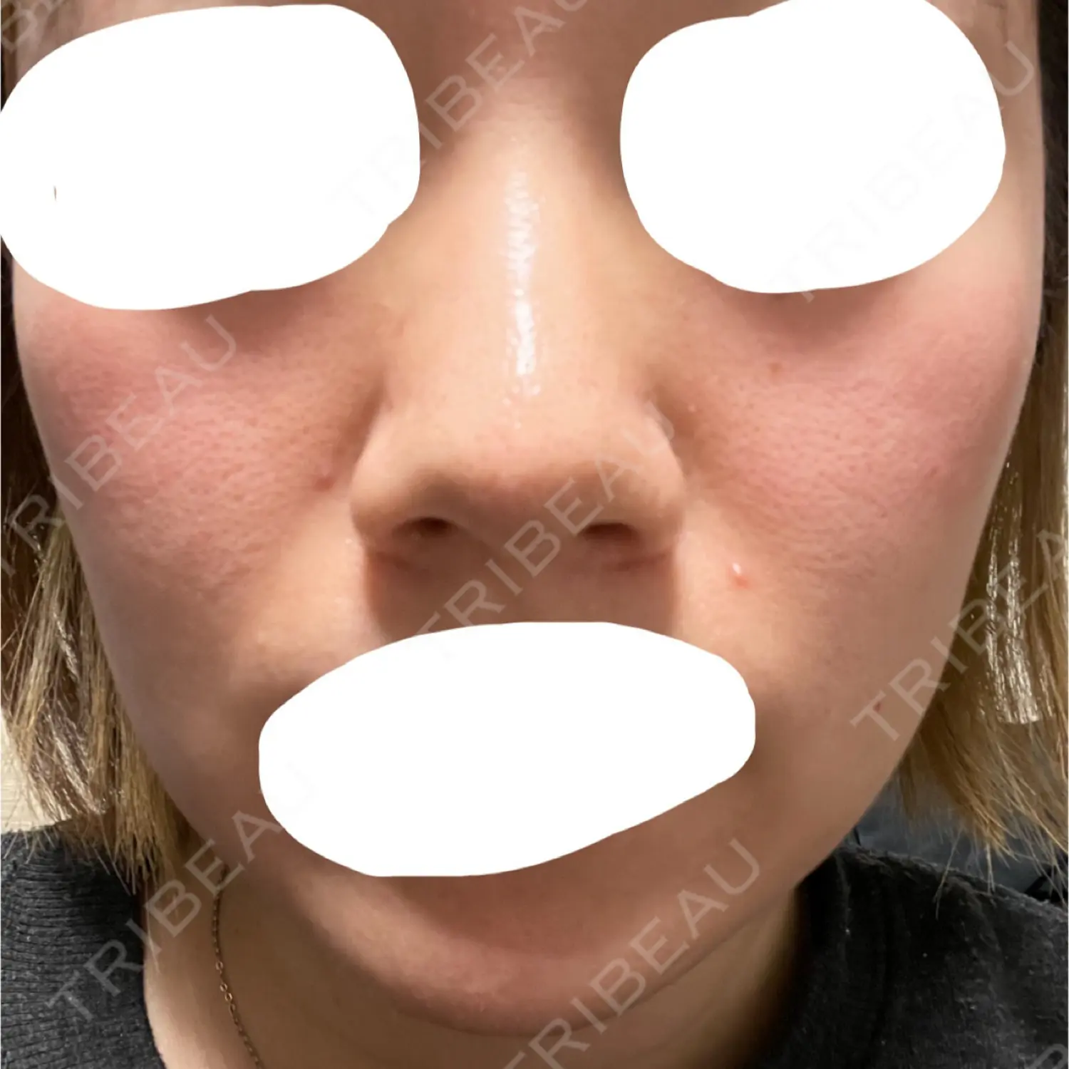 施術後の写真
