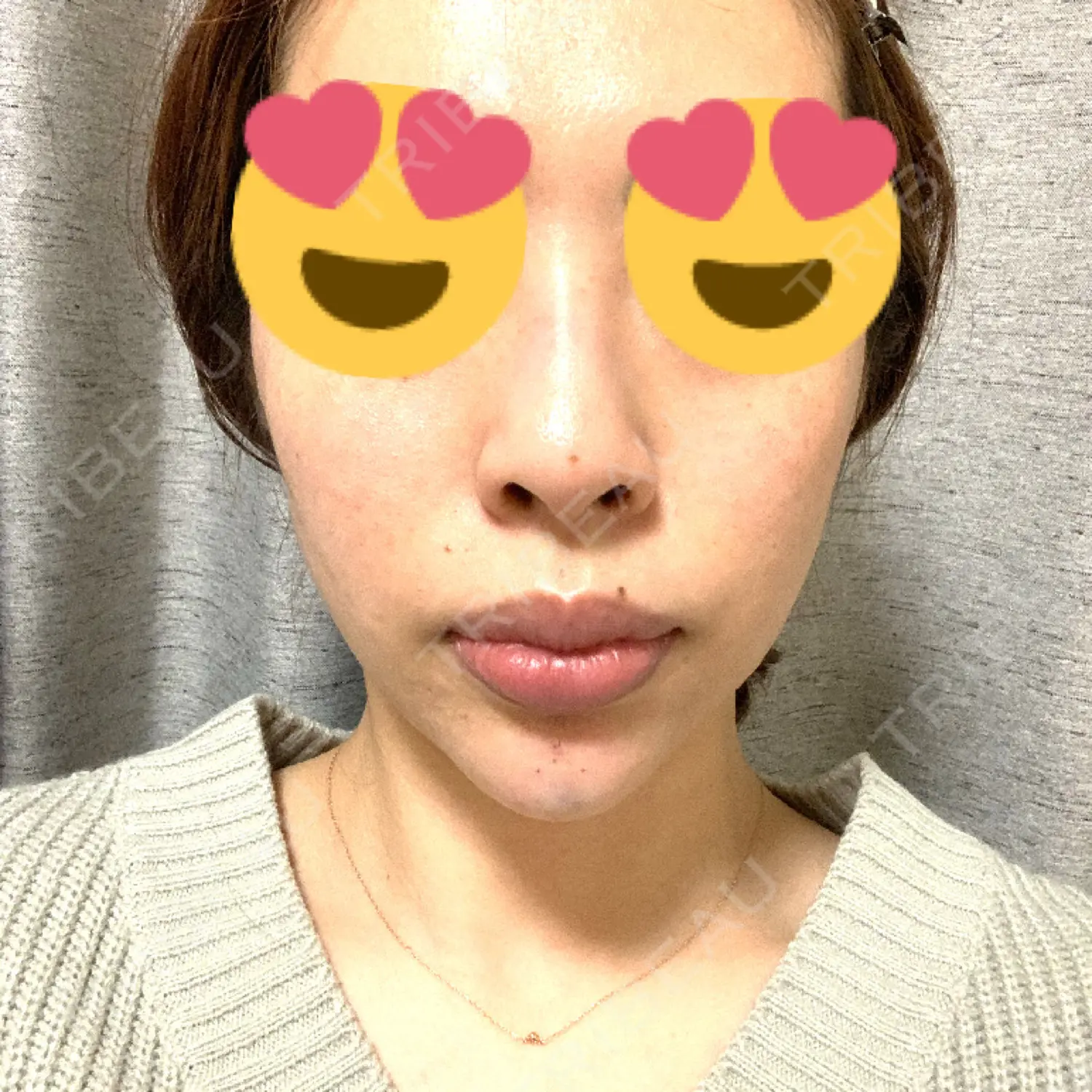 施術後の写真