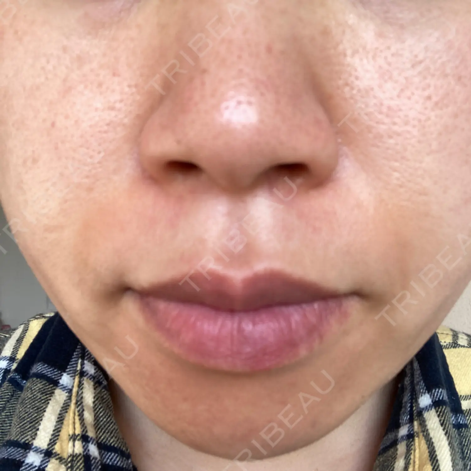 施術後の写真