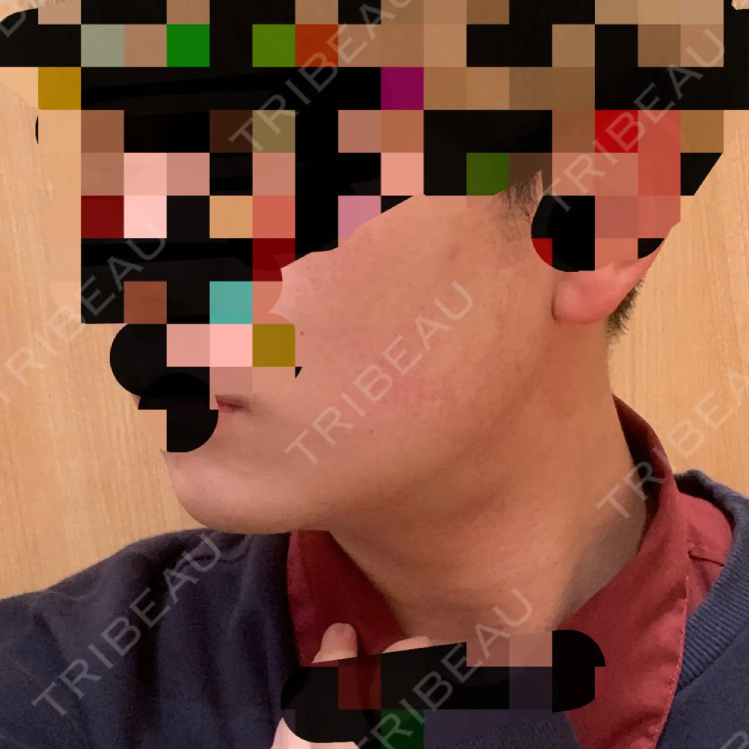 施術後の写真